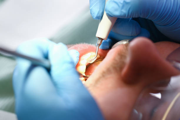 Best Emergency Wisdom Teeth Removal in West Ack, NY